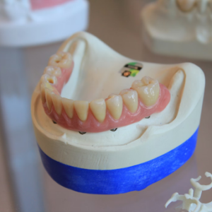 Top 5 Reasons To Choose Dental Crowns